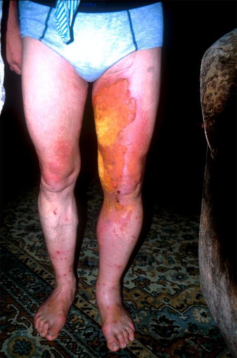 Verbrannte Beine